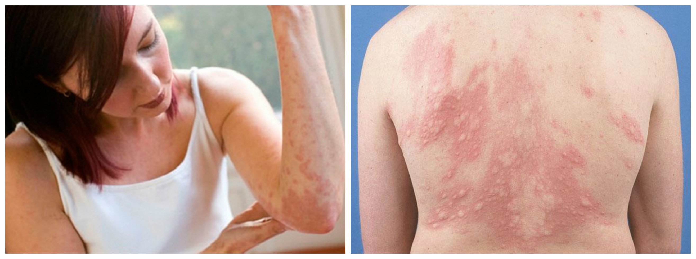 Аллергия на коже: лечение красных пятен и других проявлений